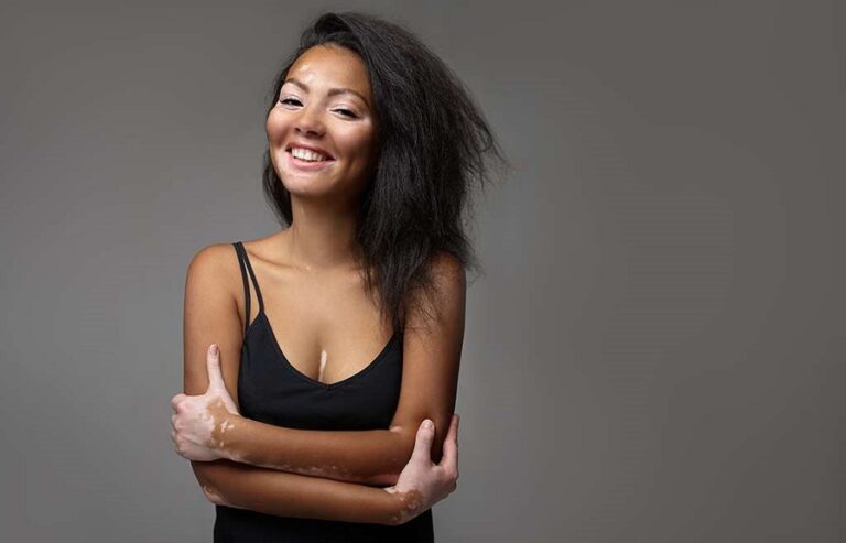 O que é vitiligo, doença não contagiosa, e quando suspeitar