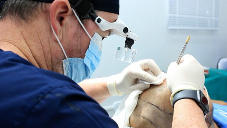 Uopeccan de Umuarama passa a oferecer transplante capilar para homens e mulheres