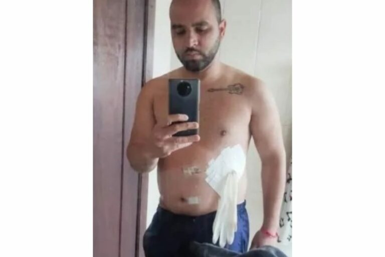 Médico coloca luva cirúrgica em paciente no lugar de bolsa de colostomia, no Paraná
