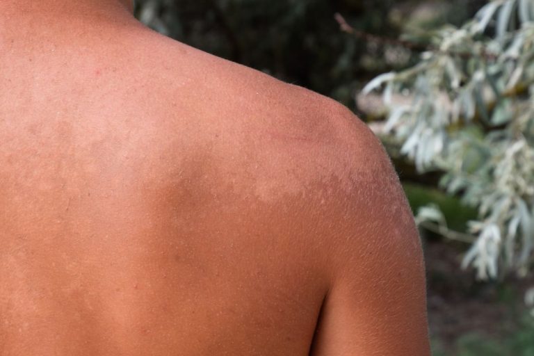 Janeiro Roxo é o mês dedicado aos debates e prevenção da hanseníase
