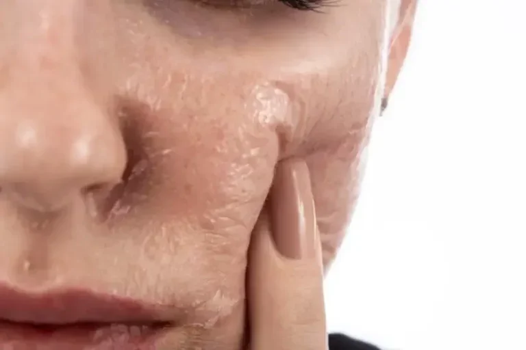 Peeling Fenol