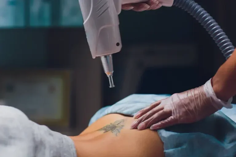 tatuagem nas costas de uma pessoa sendo removida com laser