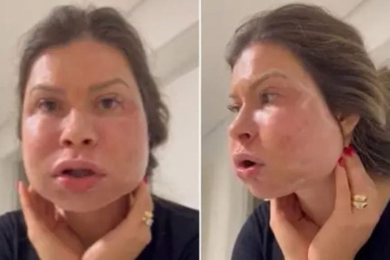 Médica e farmacêutico denunciados pelo MPPR. Na foto, a cliente que teve o rosto afetado pelo procedimento inadequado.