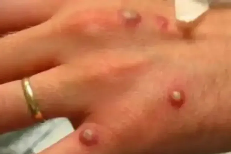 Primeiro Caso De Nova Cepa De Mpox No Brasil é Confirmado