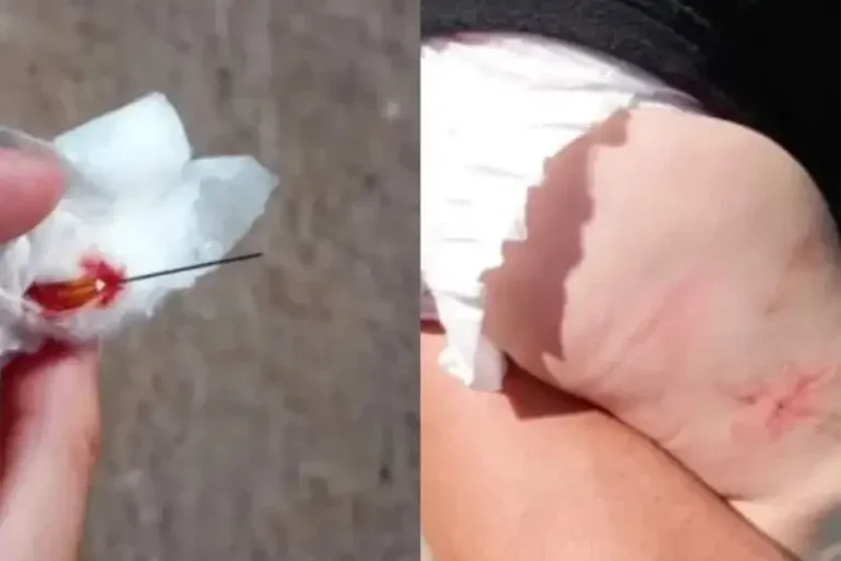Agulha é Esquecida Em Perna De Bebê