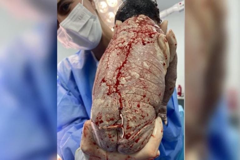 Bebê Nasce Com O Diu Da Mãe Preso Ao Corpo