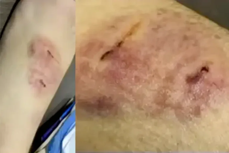 Aluno De 8 Anos Morde Professora Em Escola De Umuarama E Caso Choca Pela Violência