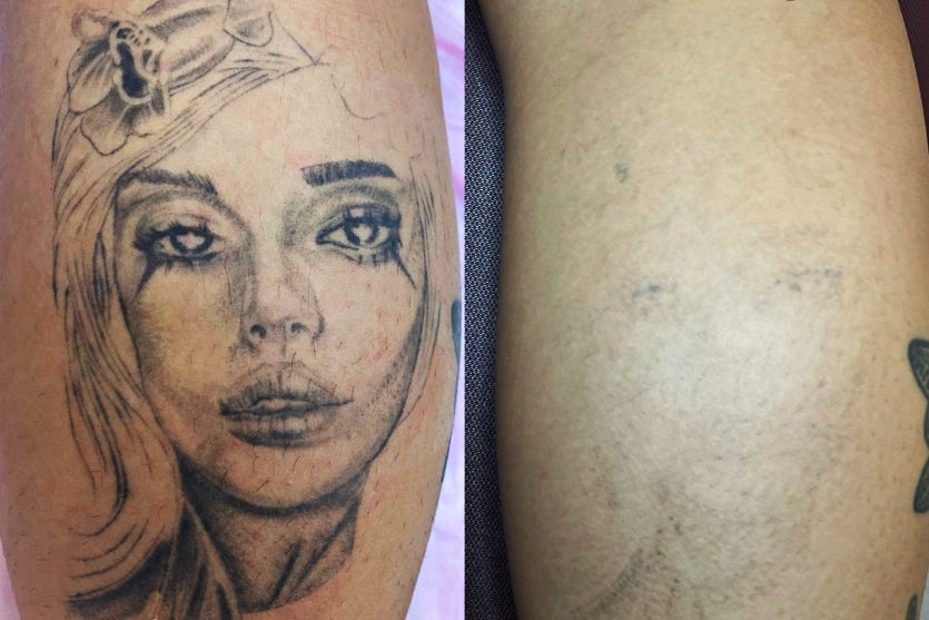 Filipi Manson é Destaque Em Congresso De Remoção A Laser (2)