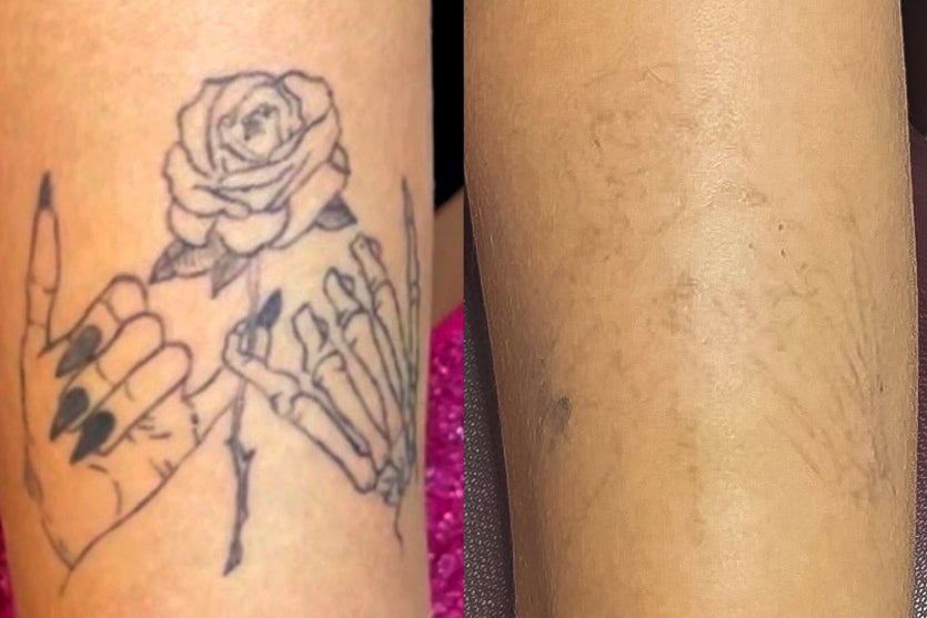 Filipi Manson é Destaque Em Congresso De Remoção A Laser (3)