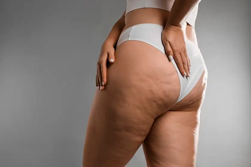 Cirurgia Para Lipedema Tratamento Que Vai Além Da Estética 3