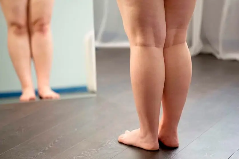 Cirurgia Para Lipedema Tratamento Que Vai Além Da Estética 4