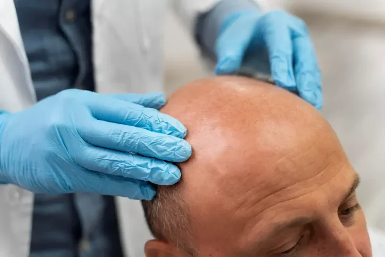 Avanços Científicos Reacendem Esperança De Cura Definitiva Para A Calvície
