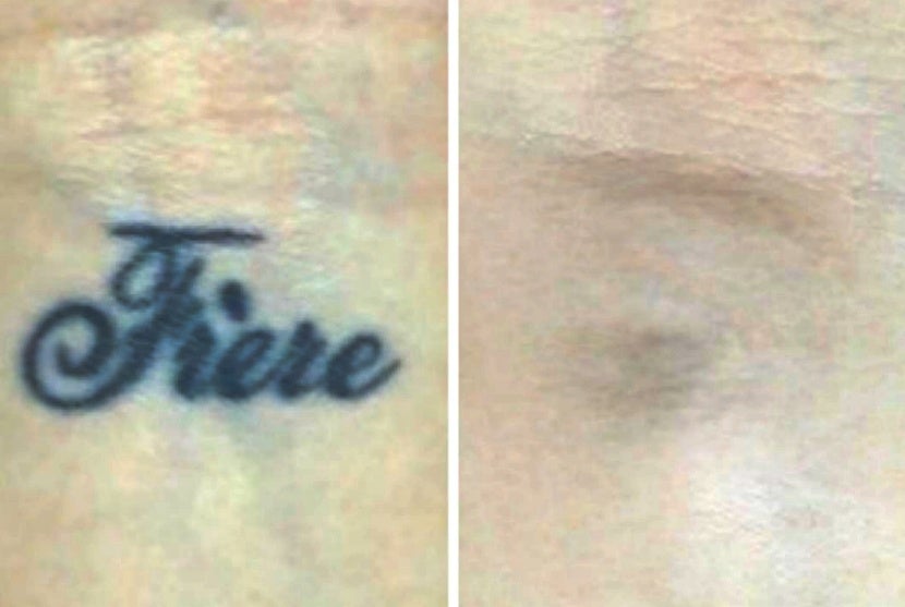 Filipi Manson é Vencedor Internacional De Despigmentação A Laser (2)