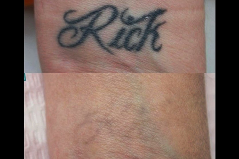 Filipi Manson é Vencedor Internacional De Despigmentação A Laser (3)