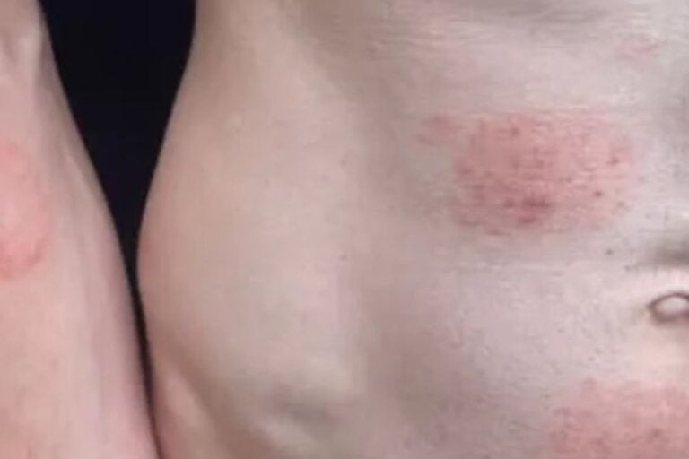 Fungo altamente contagioso transmitido por sexo acende alerta global
