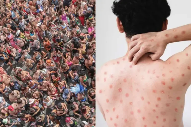 Nova cepa de Mpox é confirmada e caso no Brasil coloca autoridades em alerta