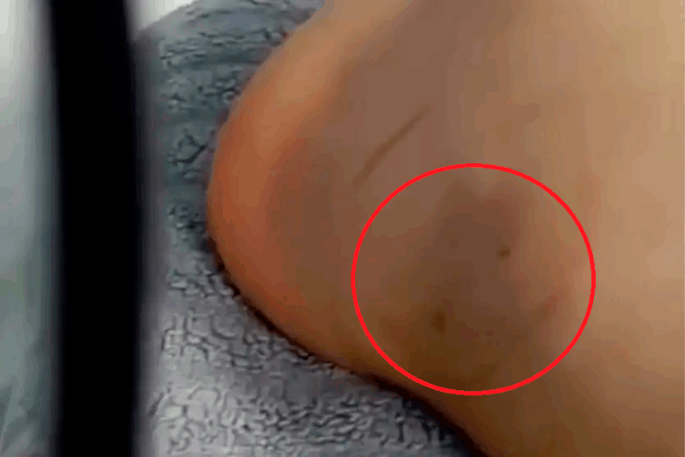 Menina de 11 anos picada por cobra em balneário de Altônia está bem; vídeo