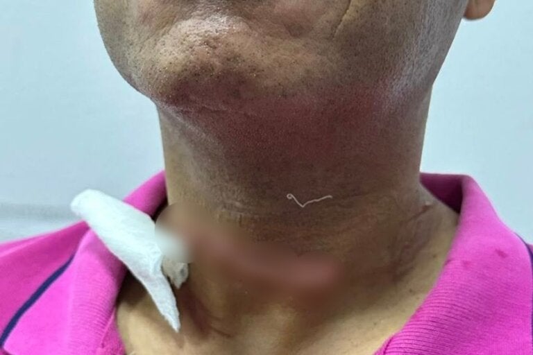 Acidente com fios arranca dedos de passageira e fere piloto no pescoço em Umuarama