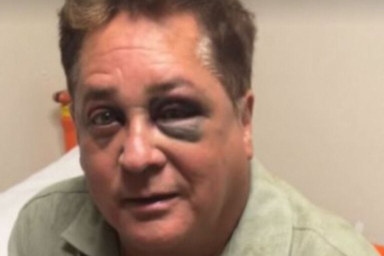 Leonardo sofre acidente durante pescaria e aparece com olho roxo