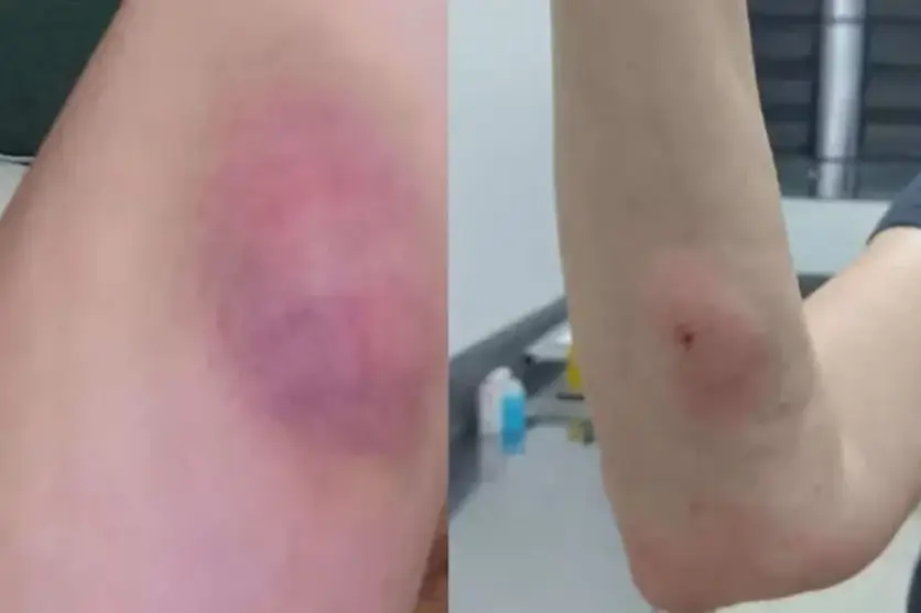 Foto do resultado da aplicação errada da injeção na tutora do cachorro.