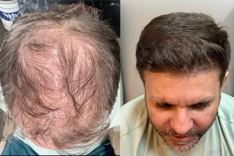 Especialista destaca sobre o impacto real do transplante capilar na autoestima