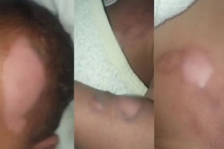 Bebê queimado durante banho em Cmei passa por cirurgia e segue internado