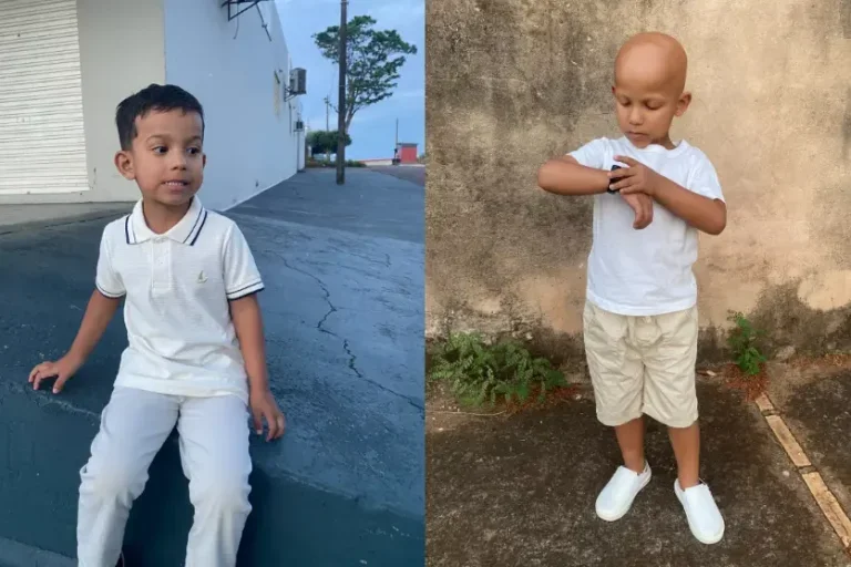 Setembro Azul: mãe relata desafios de criança de 4 anos com alopecia areata