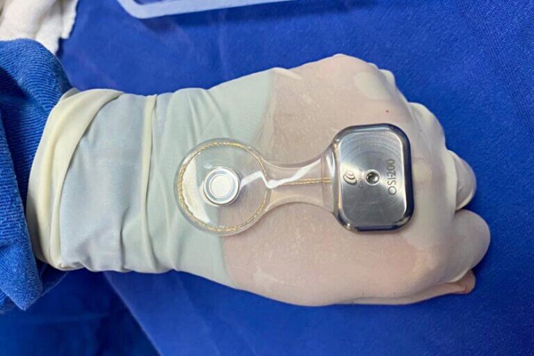 Hospital Uopeccan Umuarama amplia atendimento com implantes cocleares